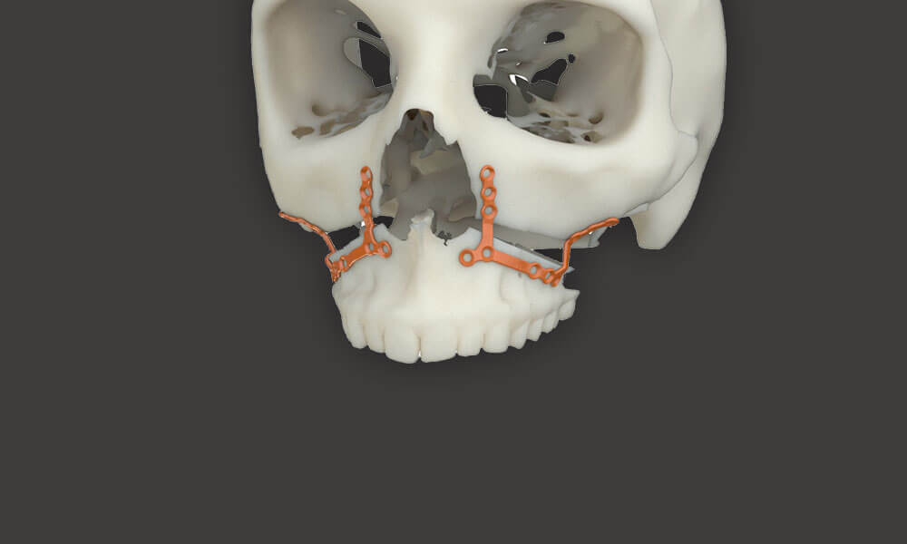 Prótese Maxilar E Mandibular Com Goma No Sistema 4 Apoiada Por