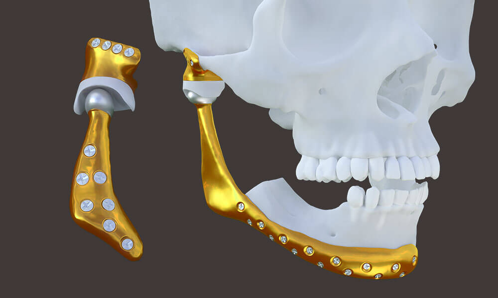 Mandíbula e Maxila c/ Fossa Articular, Implantes, Próteses e Procotolo com  4 Implantes